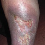 Venous Leg Ulcer