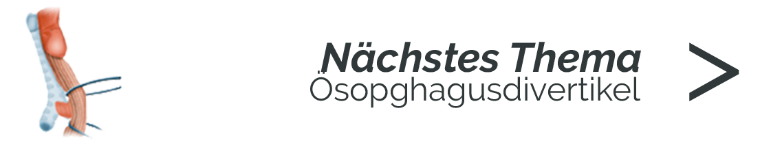 Ösophagusdivertikel