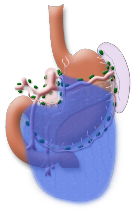Subtotale Gastrektomie bei distal lokalisierten intestinalen Tumoren