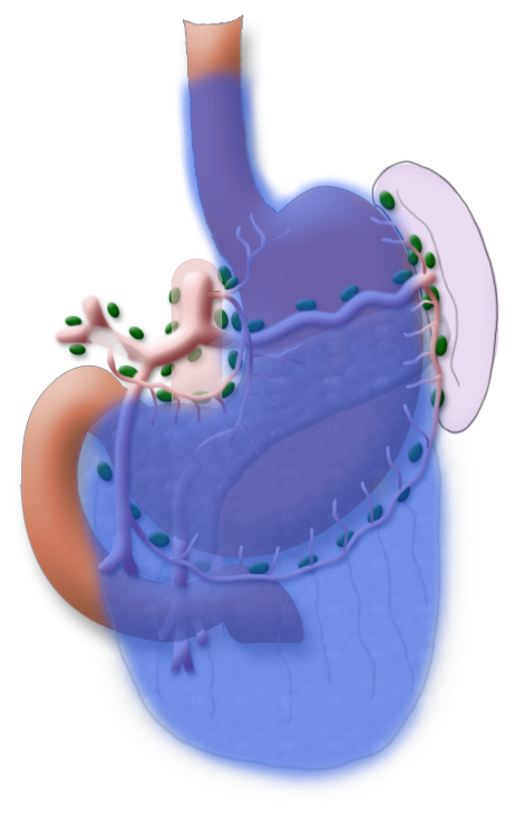 Transhiatal erweiterte Gastrektomie bei AEG II-Tumor