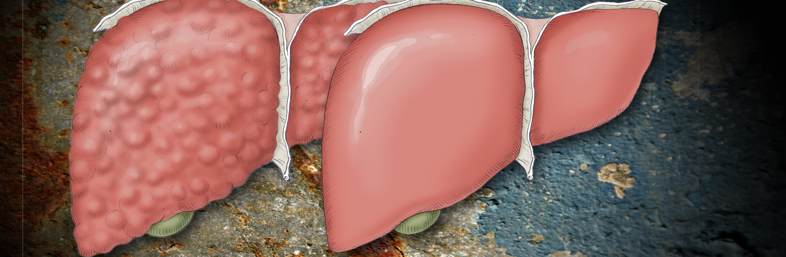 Lebertransplantation