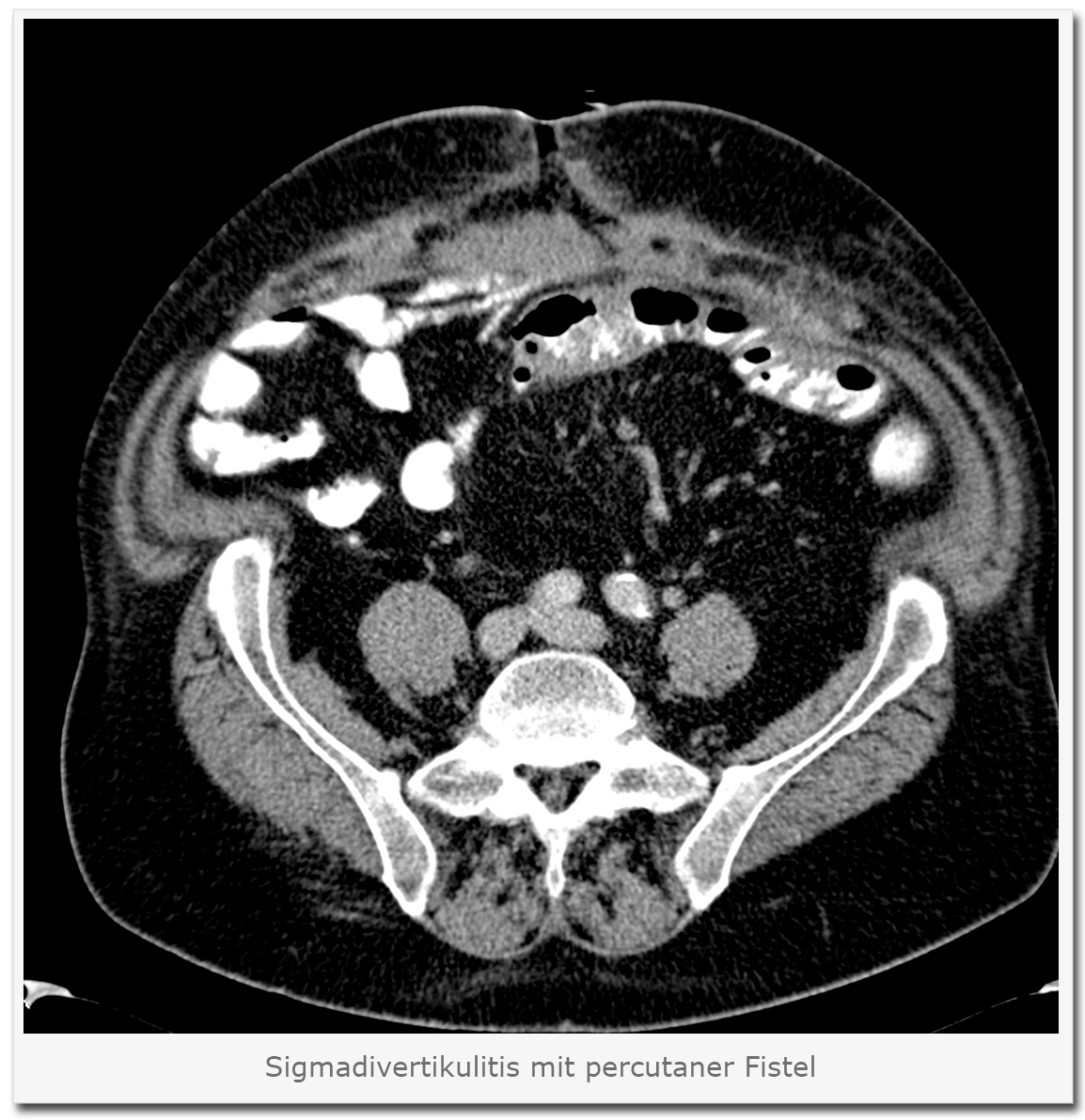 Sigmadivertikulitis mit Fistel