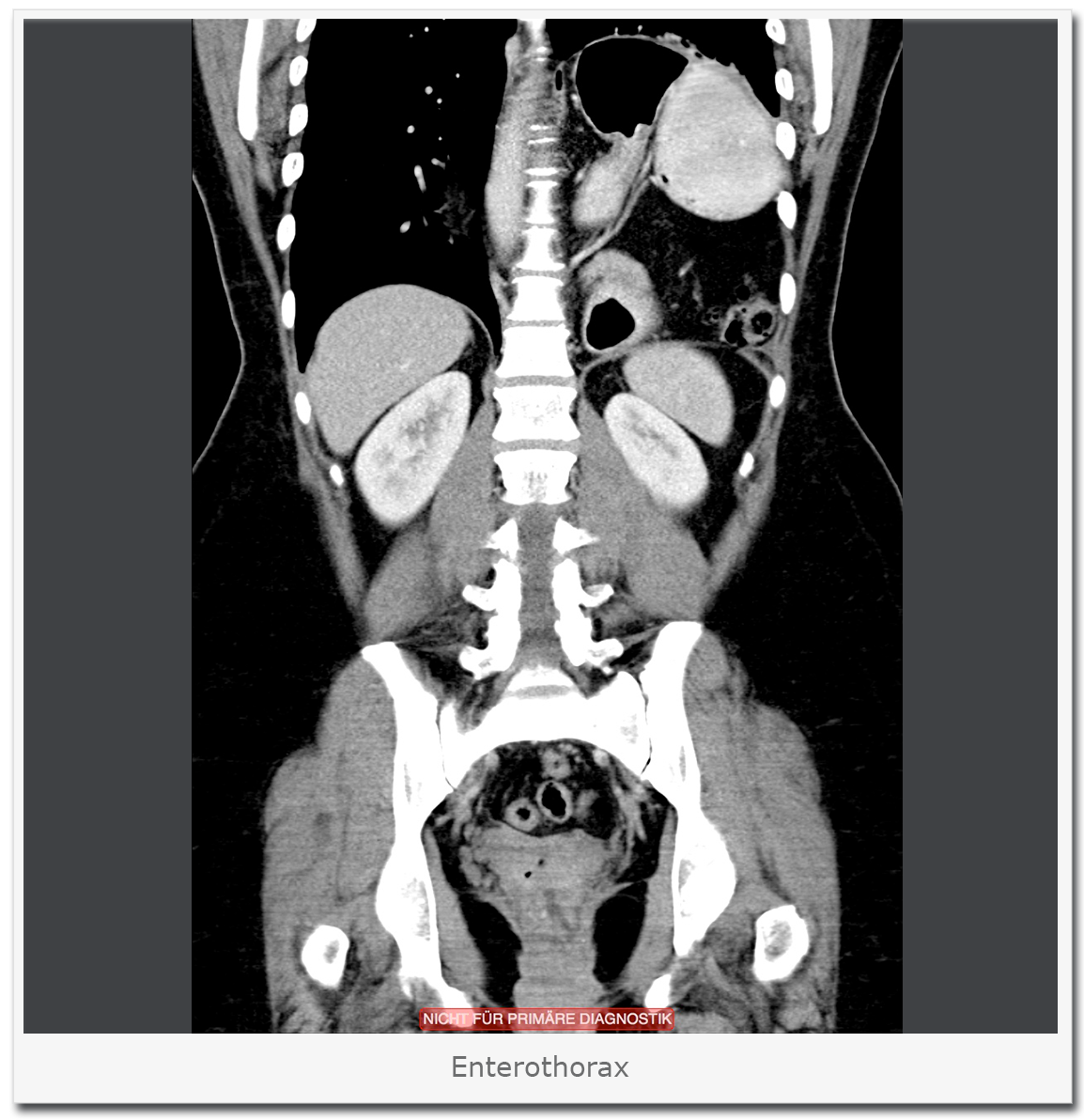 Enterothorax