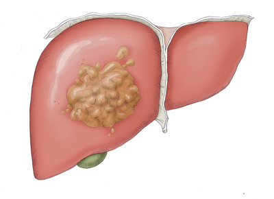Hepatocelluläres Karzinom