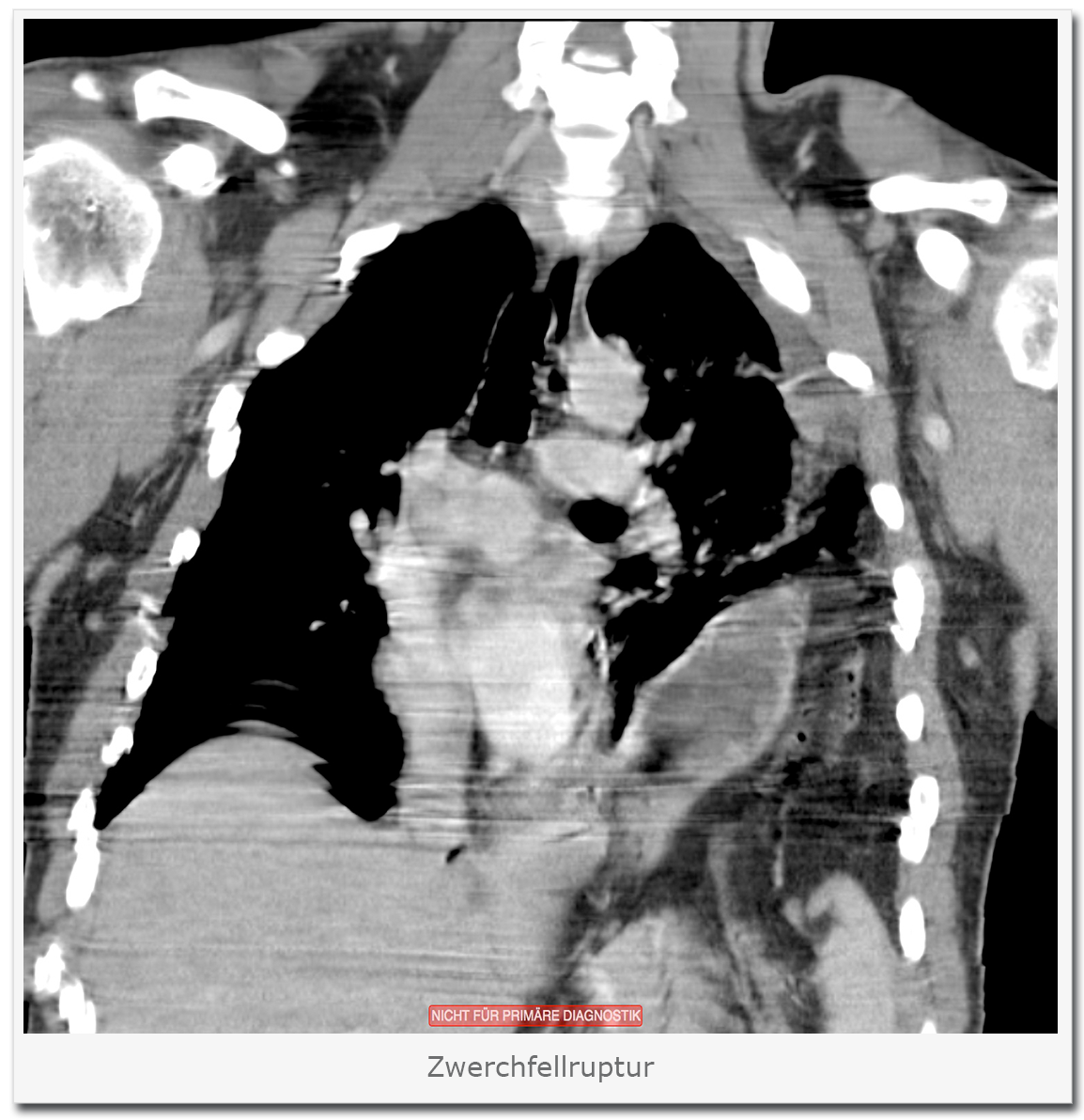 Zwerchfellruptur