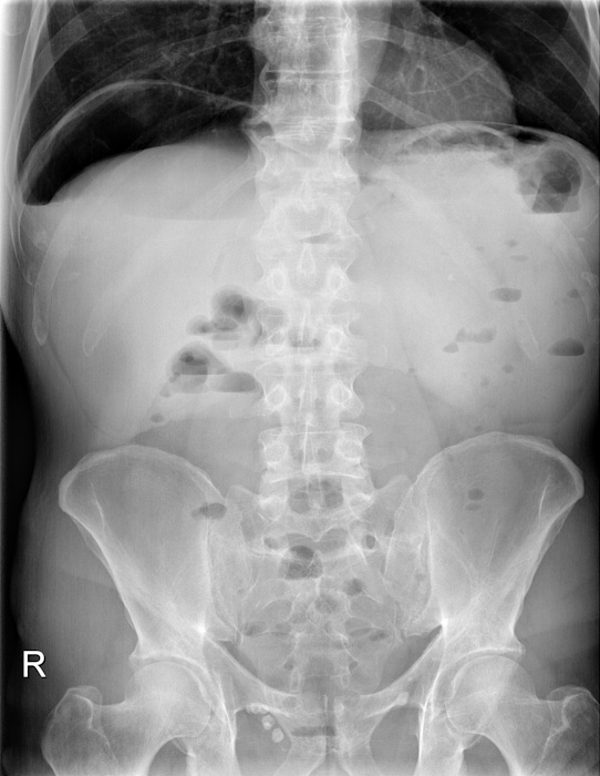 Freie abdominelle Luft bei V.a. Hohlorganperforation