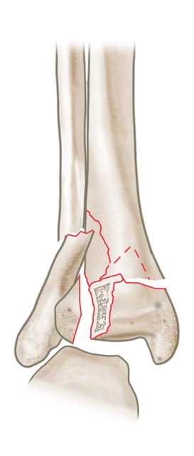 Unterschenkelfraktur