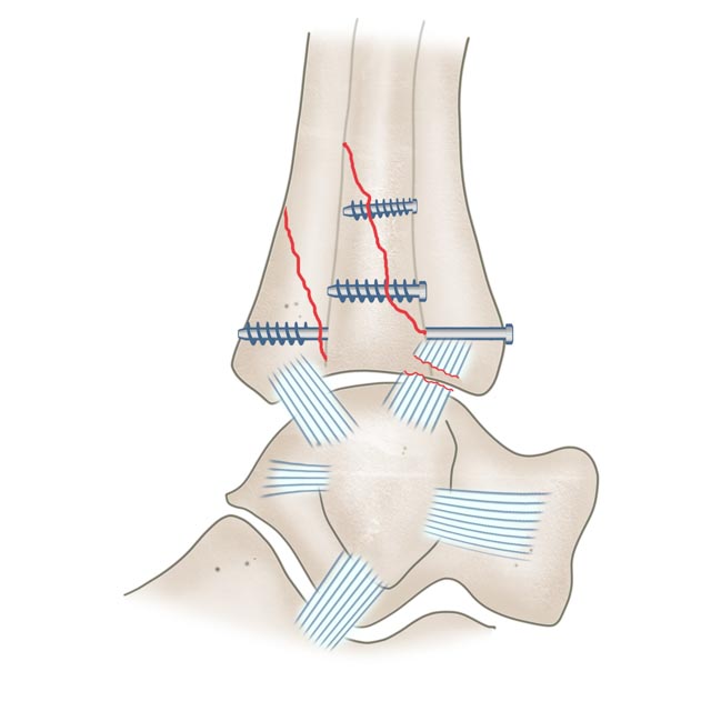 Sprunggelenksfraktur