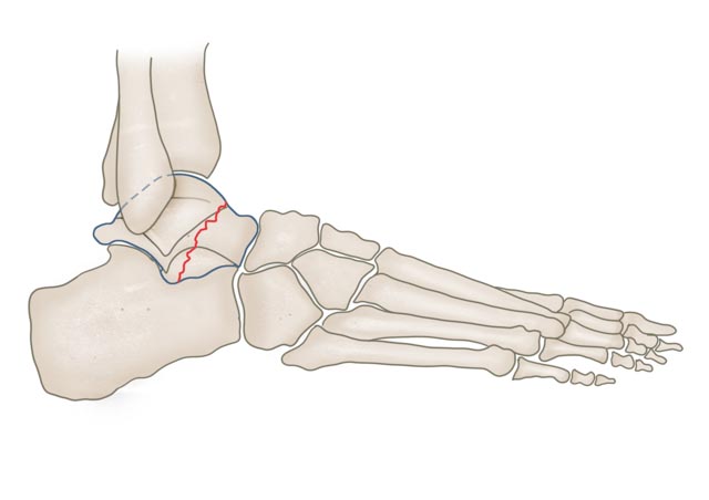 Talusfraktur
