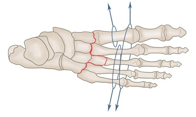 Lisfranc-Luxation