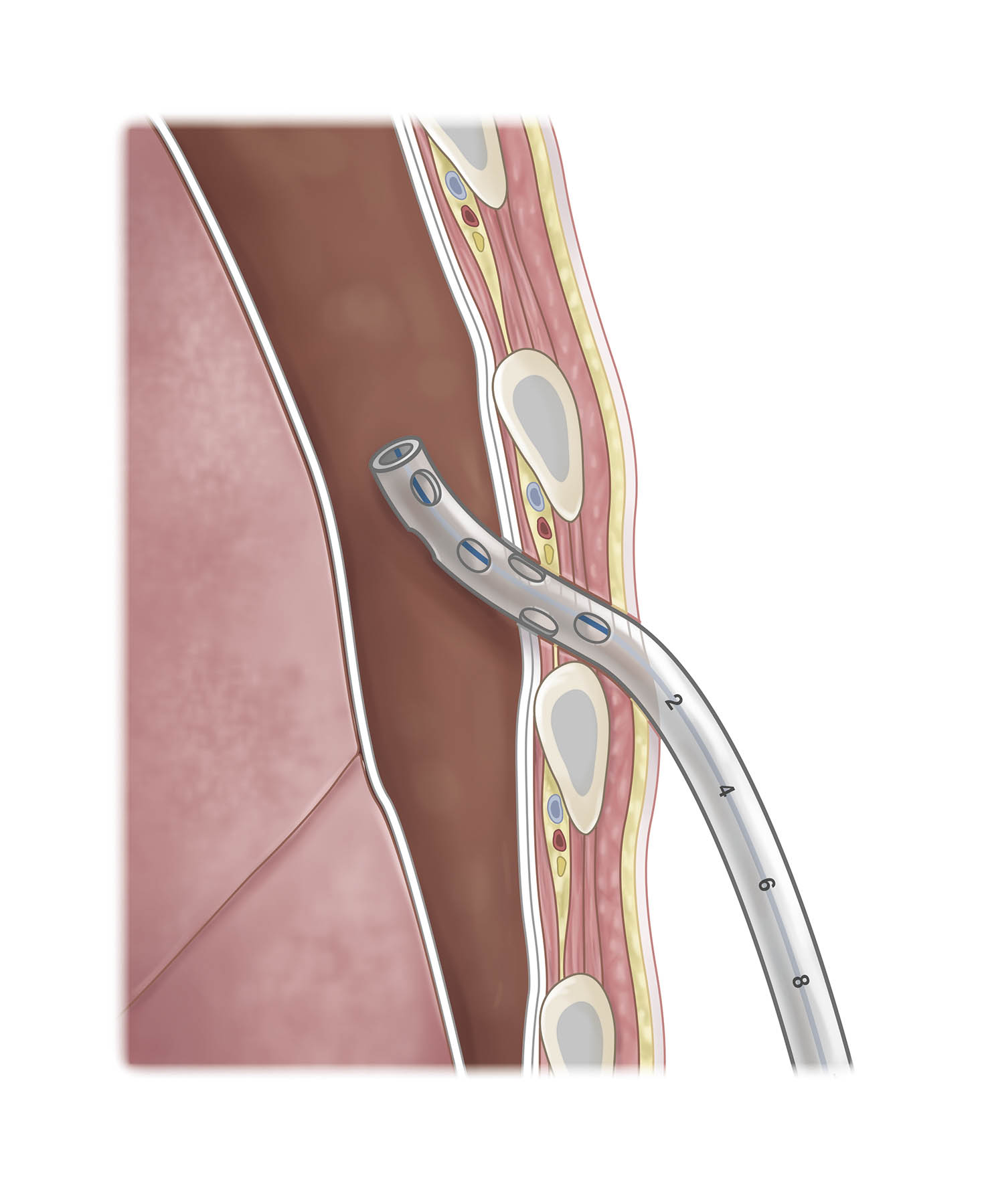 Thoraxdrainage