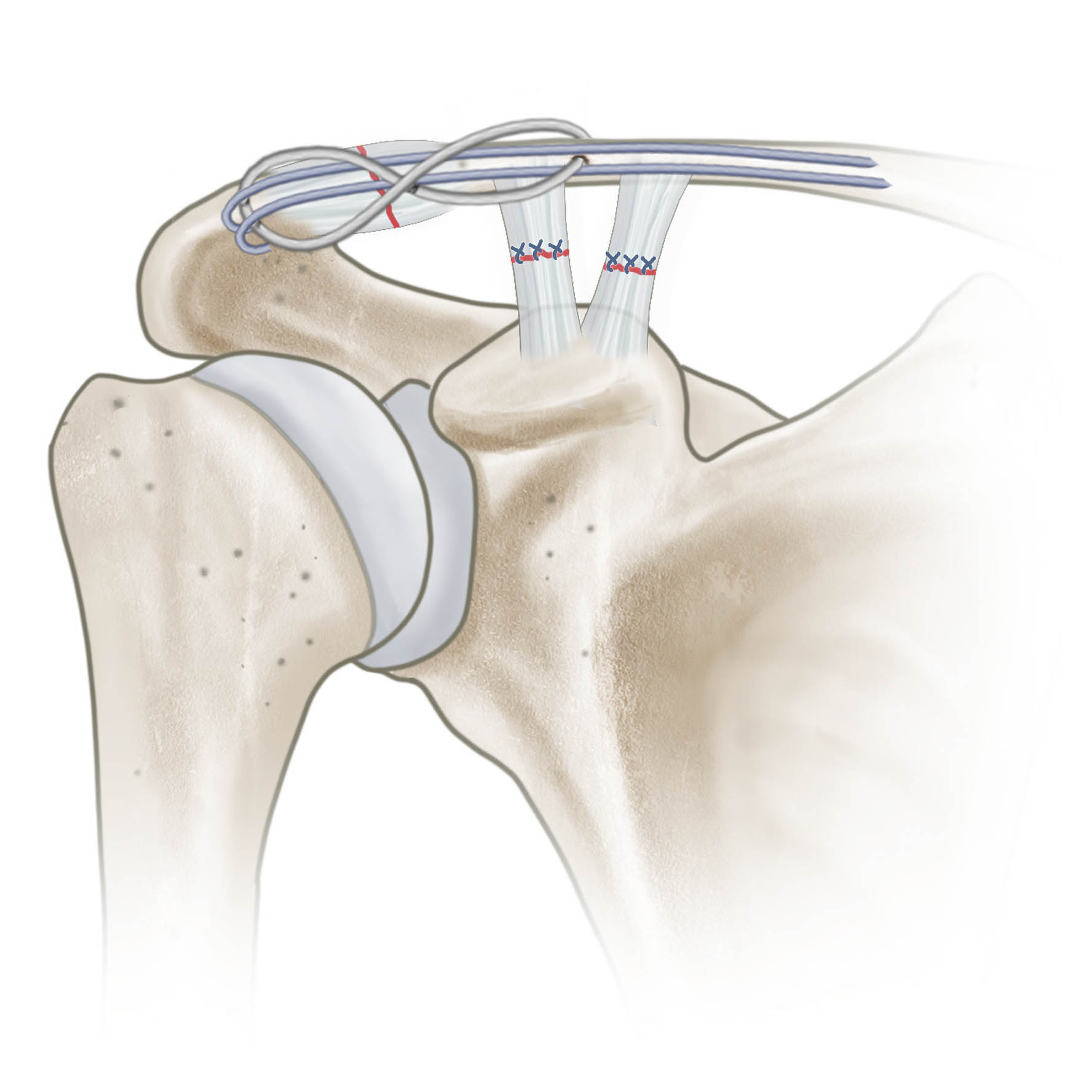 Claviculafraktur_operation