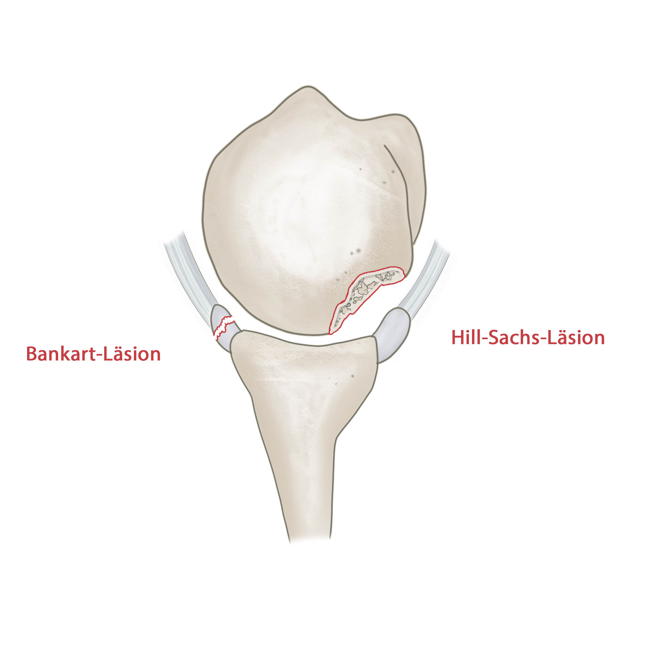 Schulterluxation