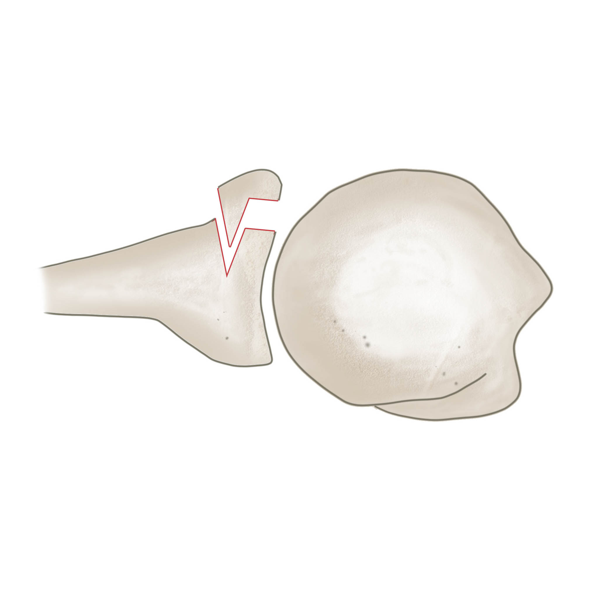 Schulterluxation