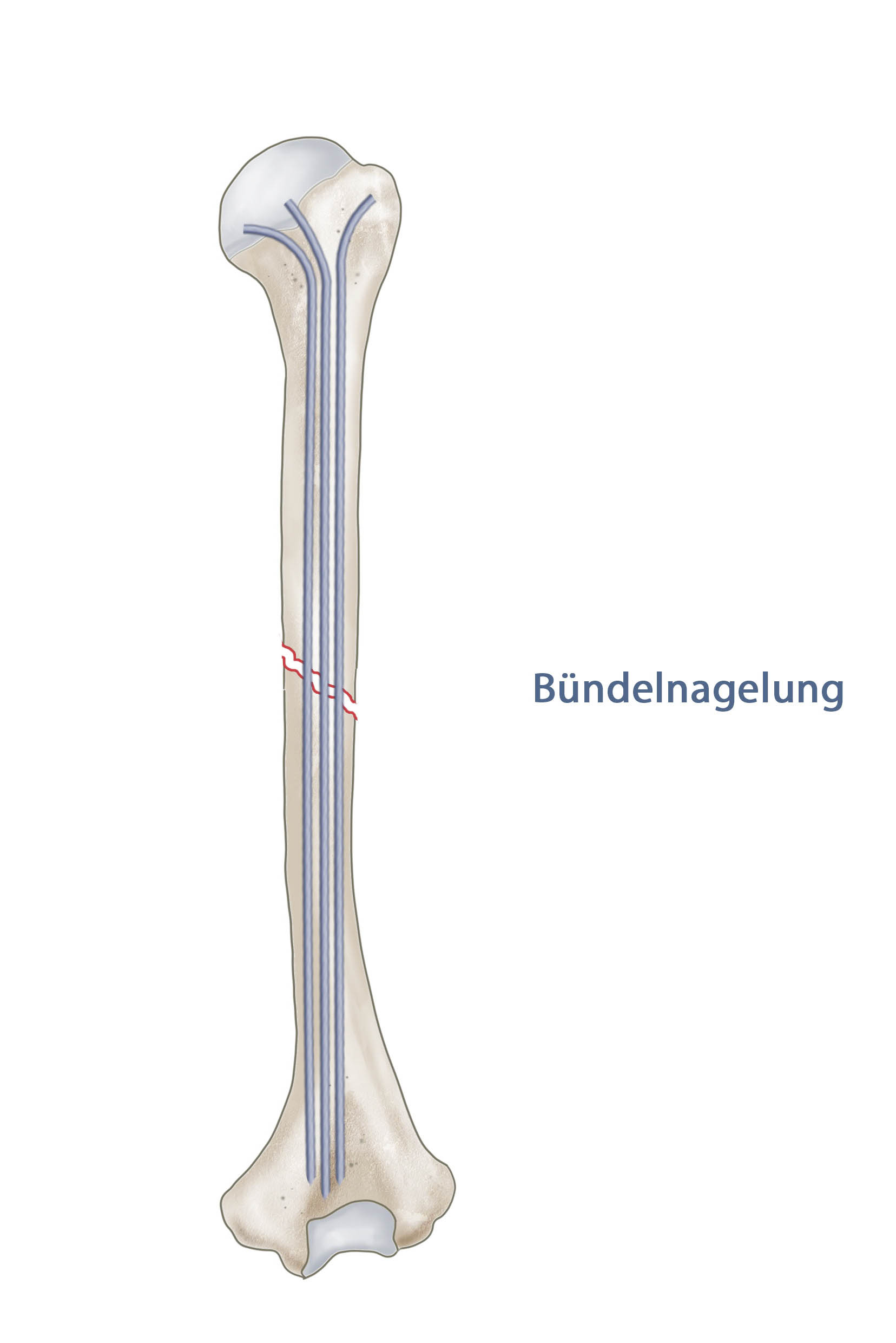 Humerusfraktur