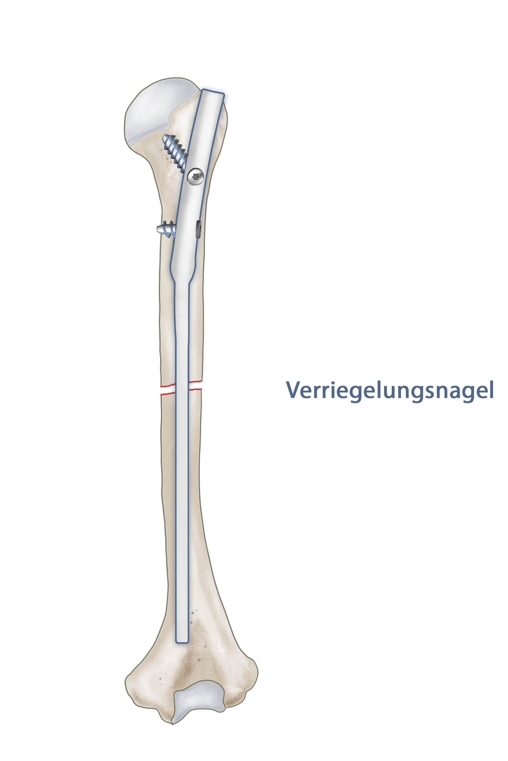 Humerusfraktur