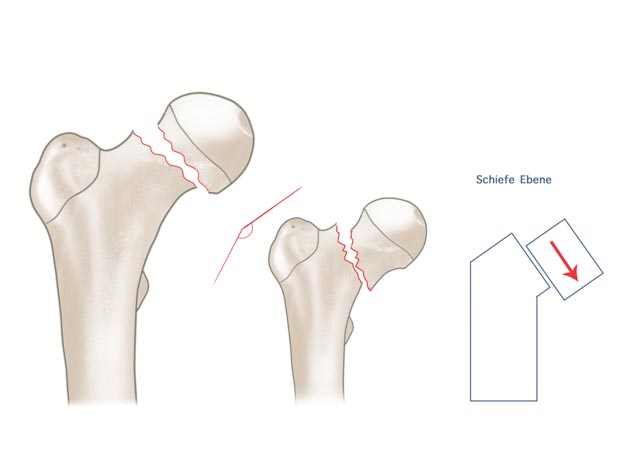 Schenkelhalsfrakturen