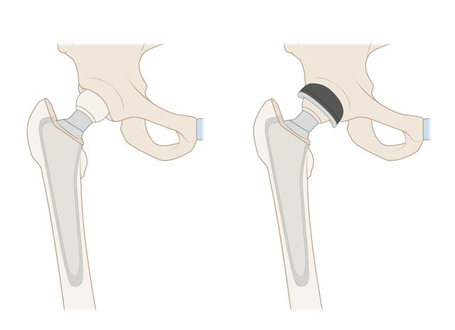 Endoprothese