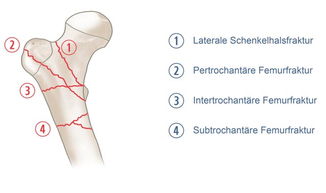 Pertrochantäre Fraktur