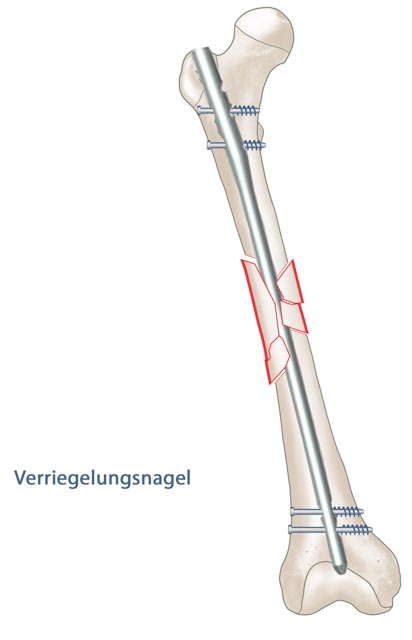 Verriegelungsnagel