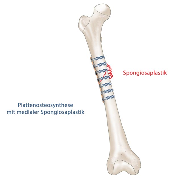 Plattenosteosynthese Femur