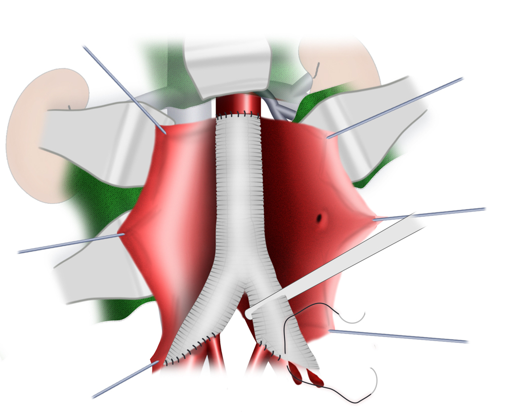 Aortenaneurysma