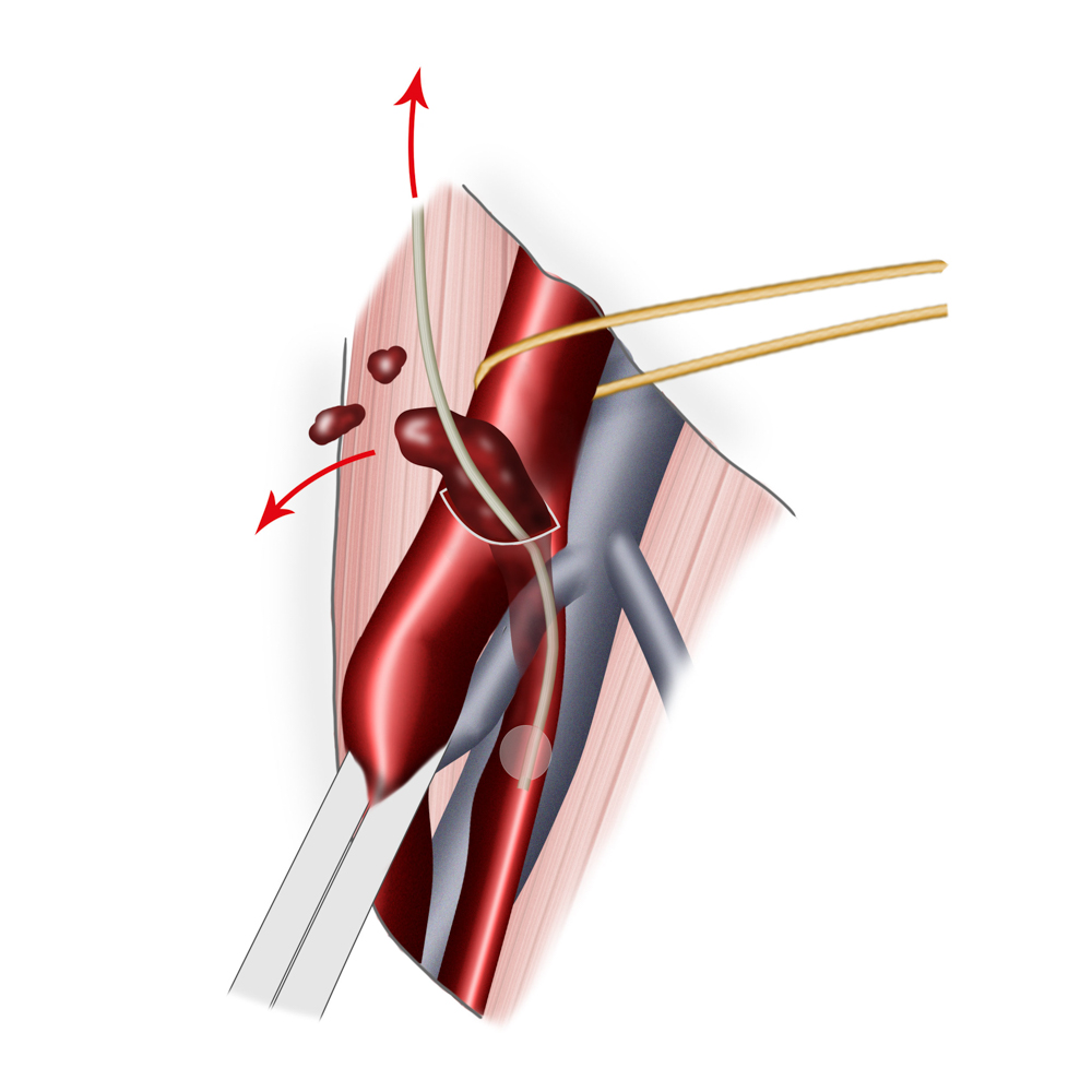 Embolektomie