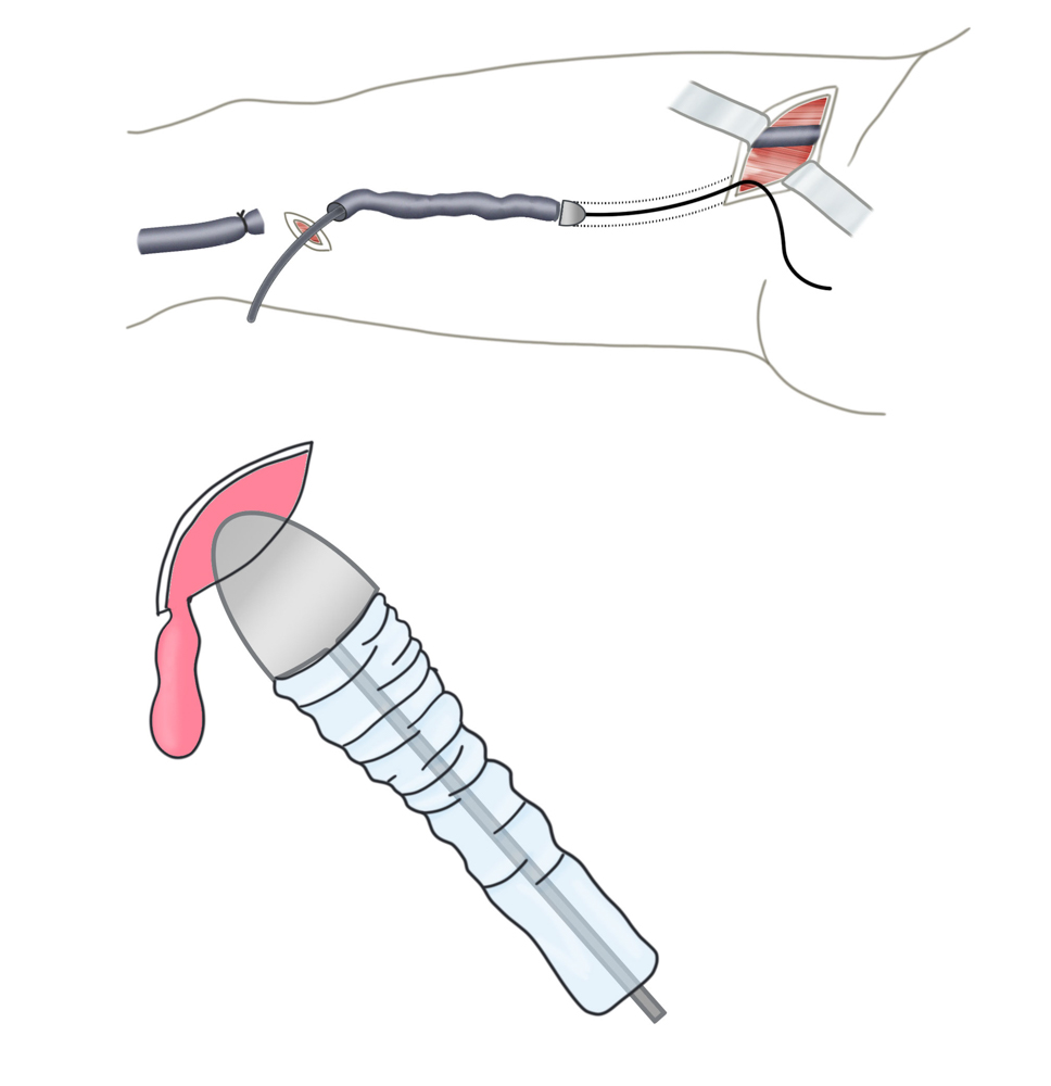 mag 30-3 venele varicoase)