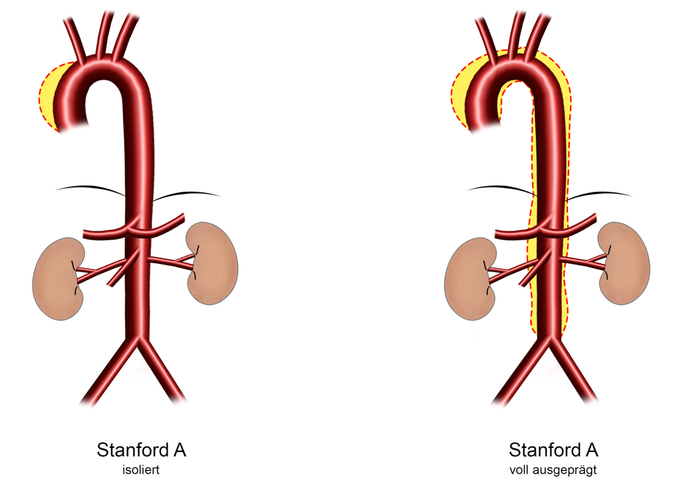 Aortendissektion