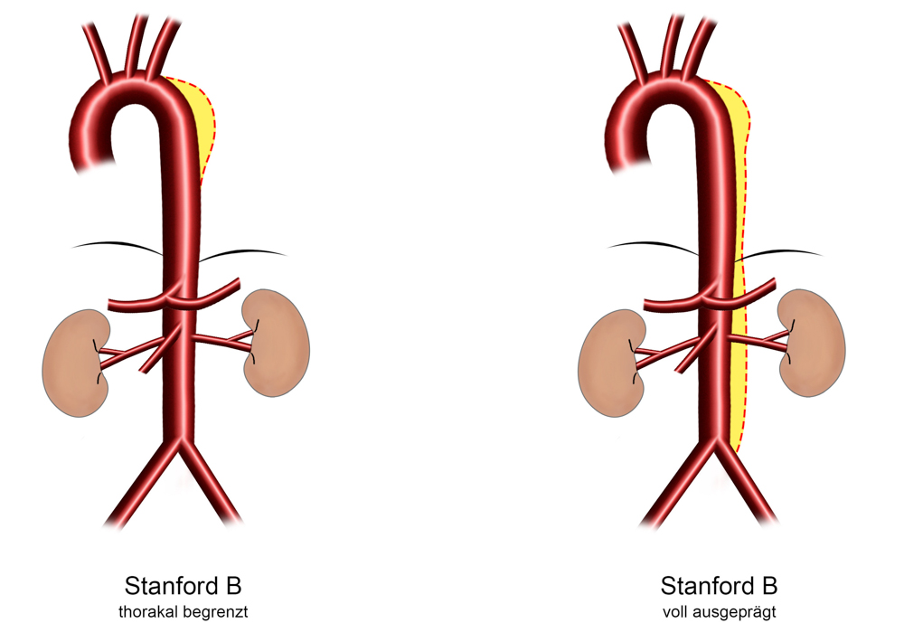 Aortendissektion