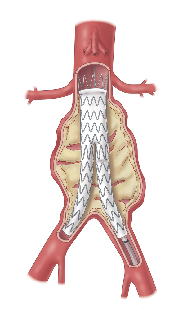 Aortenstent