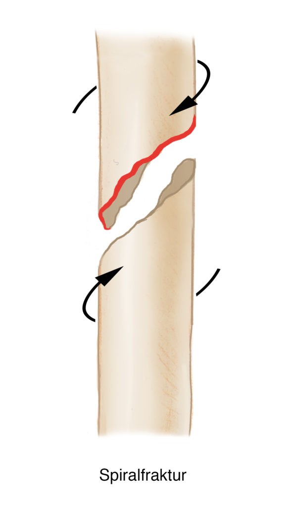 mySurgery | Frakturen