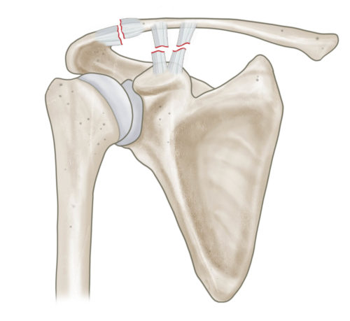 Clavicluafraktur