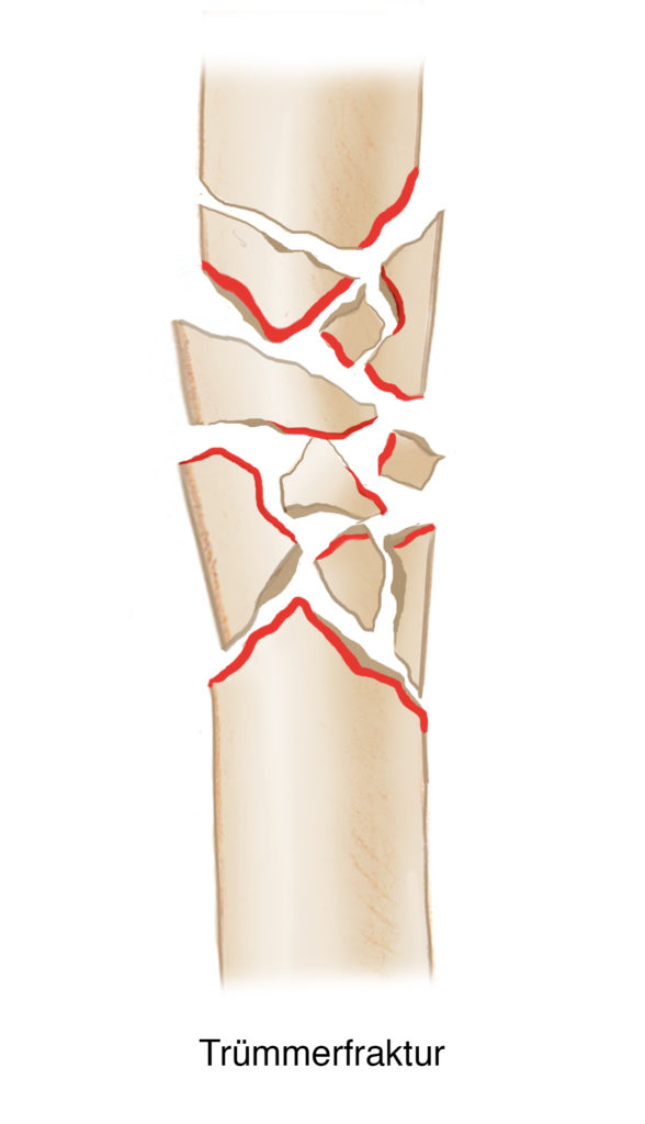 mySurgery | Frakturen