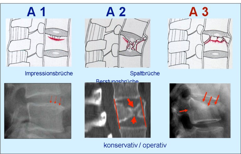 Wirbelsule 2  mySurgery