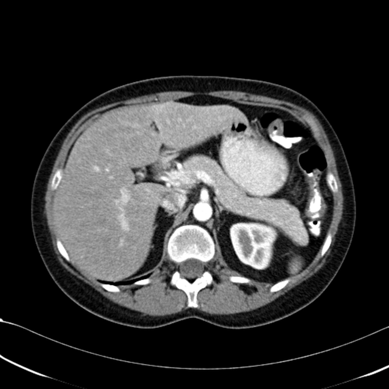 adrenal Cushing's syndrome