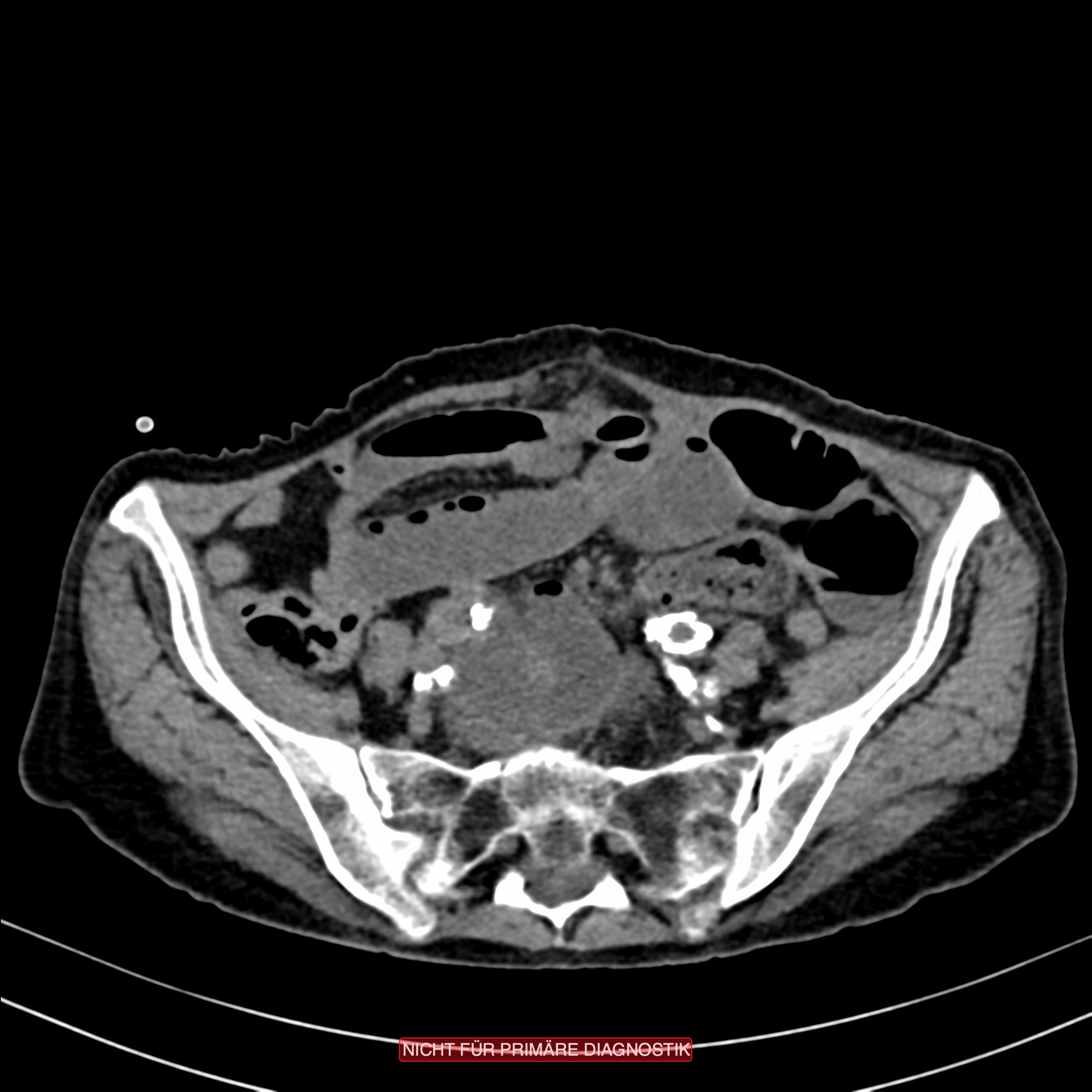 CT of Acute Abdomen 第3版 CT of the Acute Abdomen: GU Applications Part 1 - YouTube