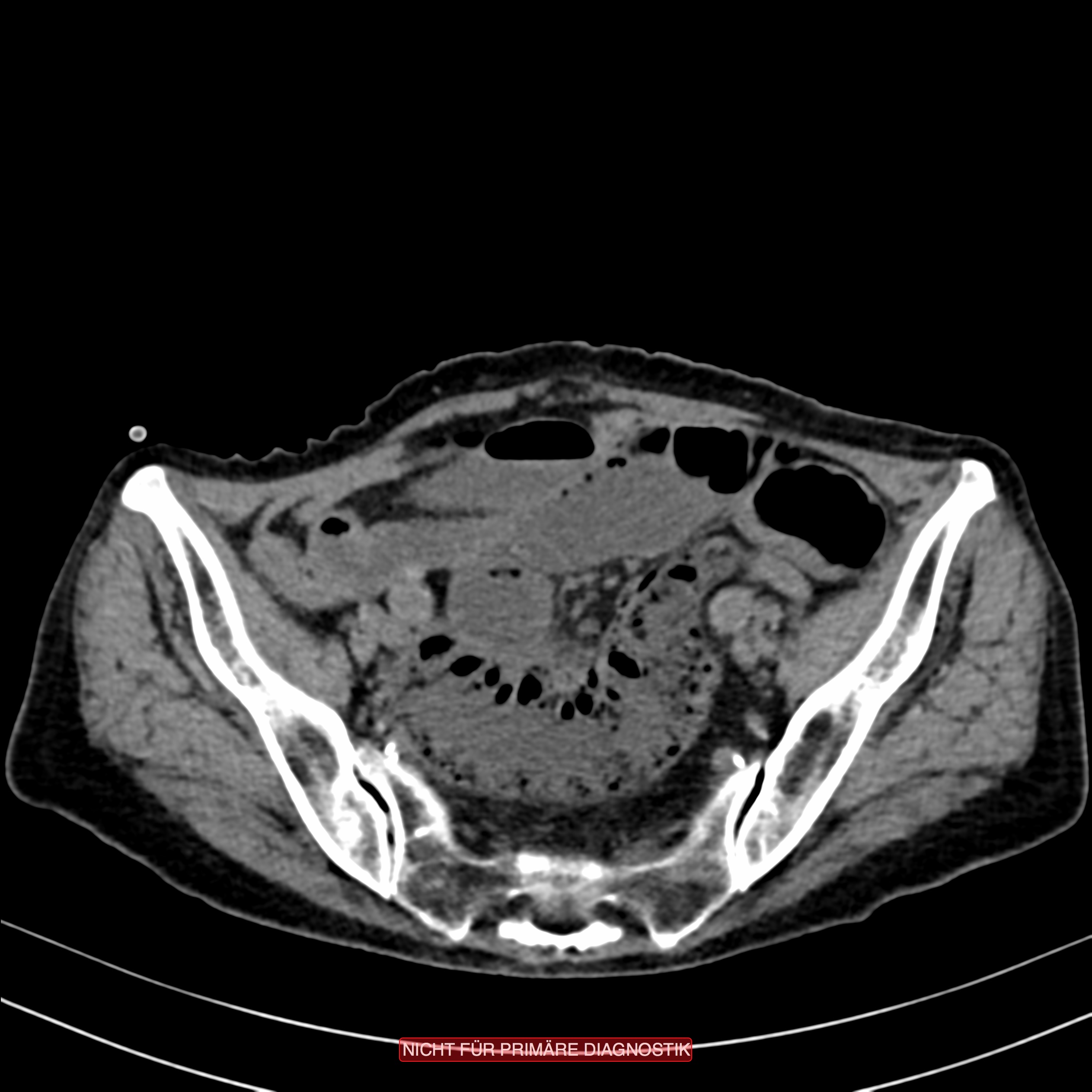 CT of Acute Abdomen 第3版 CT of Acute Abdomen 第3版 Approach to CT scan of the Acute