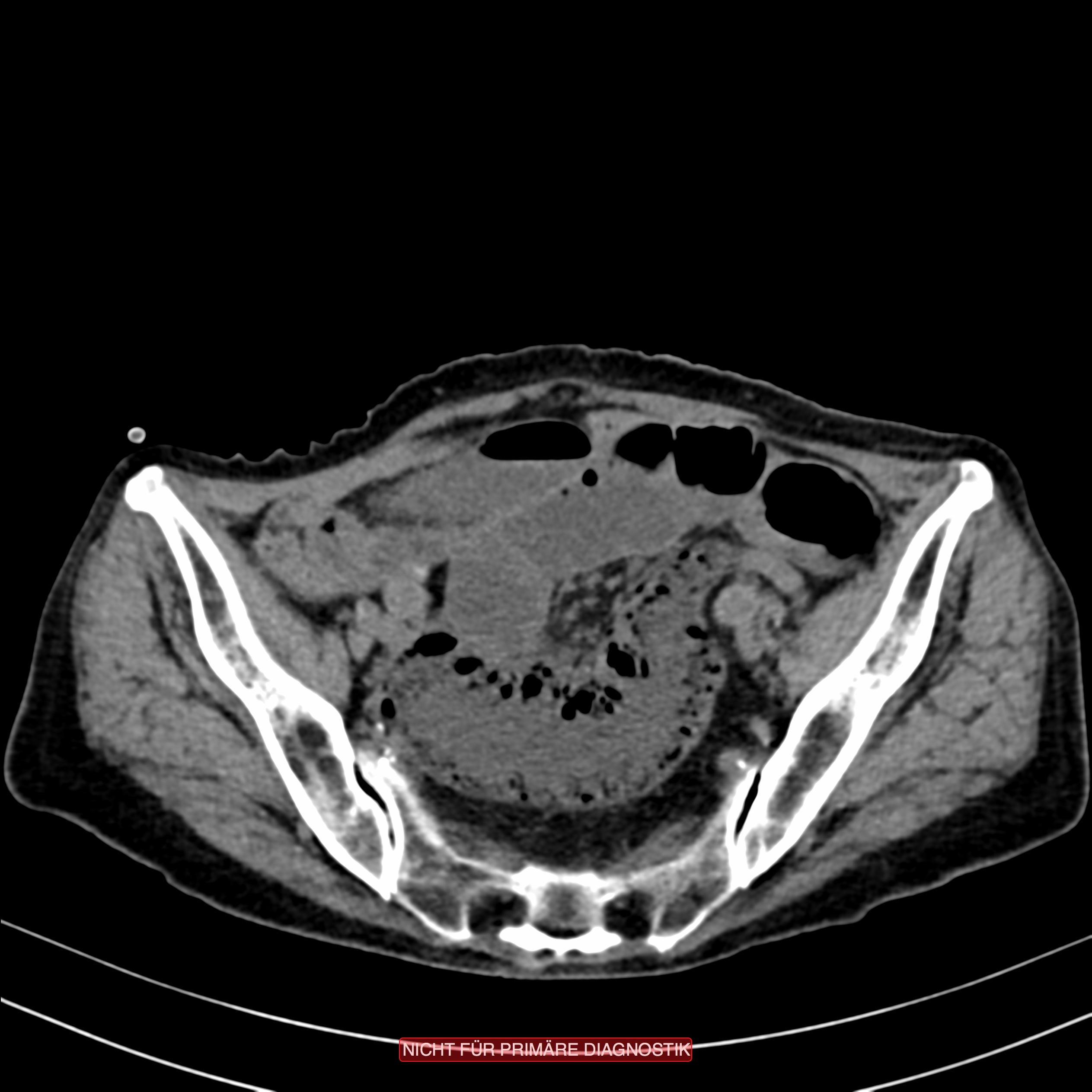 CT of Acute Abdomen 第3版 CT of the Acute Abdomen | SpringerLink